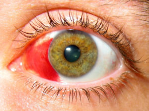 Что означает кровь на глазе. Что делать, если глаз залило кровью? Причины и методы лечения