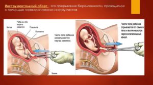 Тошнит после медикаментозного прерывания беременности что делать. Возможные осложнения и последствия медикаментозного аборта. Боли и спазмы после медикаментозного аборта