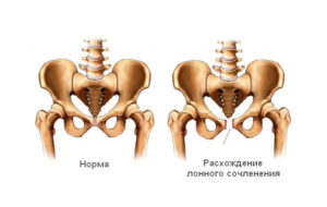Когда сходятся кости таза после родов. Почему болит лобковая кость и отекает после родов