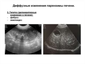 Ультразвуковой синдром диффузного поражения печени. Эхографические признаки диффузных изменений структур печени