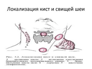 Срединная киста шеи операция послеоперационный период реабилитация. Срединная киста шеи у ребёнка. Диагностика срединной кисты