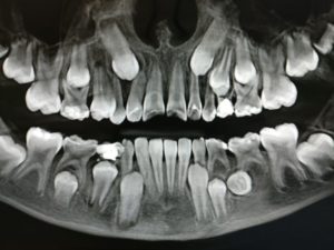 Нет зачатков коренных зубов что делать. Бывают ли у взрослых молочные зубы