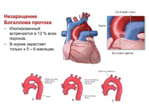 Открытый артериальный проток фото