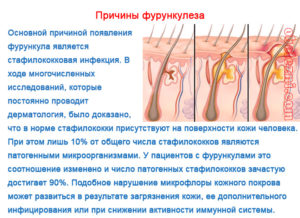 Вскочил фурункул на груди – что это такое и как бороться с проблемой. Фурункул на грудях: описание, причины появления, симптомы, необходимое лечение и профилактика заболевания