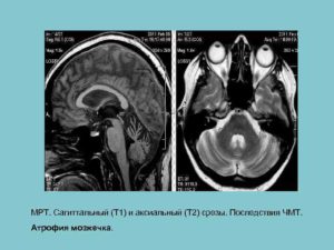 Клиническая картина и лечение атрофии мозжечка. Атрофия мозжечка последствия