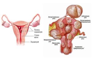 Как удаляется интрамуральный узел матки. Миома матки: что означает диагноз интрамуральный миоматозный узел? Осложнения и лечение