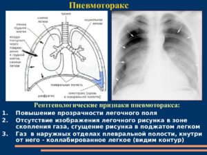 Обзор по рентгенологической диагностике пневмоторакса. Пневмоторакс: рентгенологическая диагностика Спонтанный пневмоторакс рентгенологическая картина