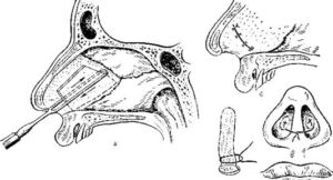 Что такое резекция носовой перегородки. Подслизистая резекция носовой перегородки. Резекция сигмовидной кишки - причины, показания, прогноз и последствия
