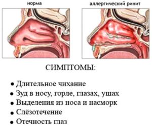 Причины и лечение постоянного зуда носа снаружи. Зуд в носу, чихание, насморк — о чем говорят симптомы