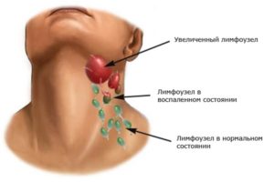 Какой врач лечит лимфоузлы? Воспалился лимфоузел: причины, к какому врачу обратиться, методы лечения