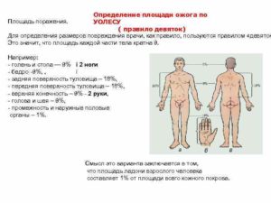 Ожоги: площадь ожогов, определение по правилу ладони. Классификация ожогов по площади и степени поражения. Методы определения площади ожога