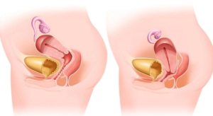 Опущение матки: симптомы, стадии, лечение, профилактика. Почему яичник припаян или находится за маткой
