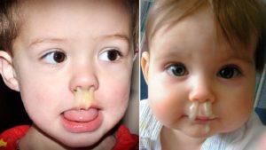 Что делать если у ребенка заложен нос и текут сопли? У ребенка постоянно заложен нос и сопли что делать