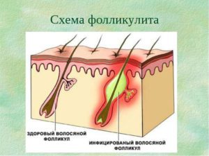 Воспалился волосяной фолликул. Прыщи в волосяных луковицах. Провоцирующие факторы заболевания