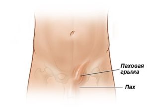 Опухла правая сторона паха у мужчины. Почему появляется опухоль в паху у мужчины