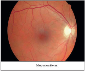 Кистозный отек макулярной области. Макулярный отек сетчатки глаза