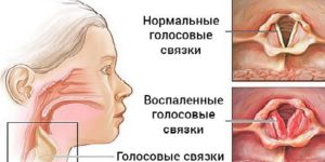 Сели связки пропал голос лечение. Сел голос: что делать, горло не болит