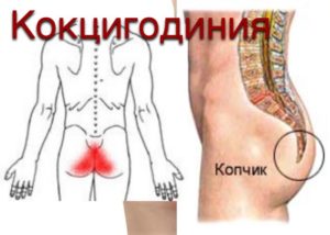 Болит копчик к кому обратиться. К какому врачу обращаться если болит копчик