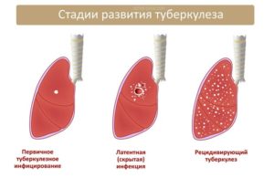 Как выявить туберкулез в домашних условиях. Как выявить туберкулез легких на ранних стадиях