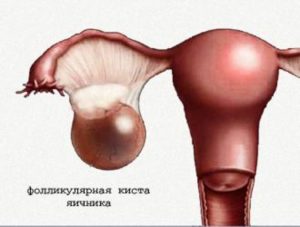 Жидкостное образование правого яичника. Кистозное образование правого яичника