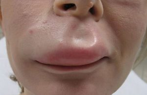 Сбоку верхняя губа опухла. Как помочь народными методами. Лечение отека у взрослых