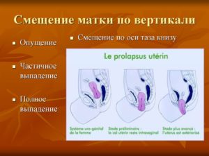 Смещение матки при беременности немного влево. Смещение матки