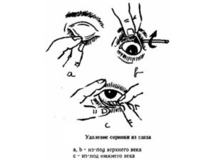 Соринка под веком как вытащить. Если в глаз попала соринка — что делать и как оказать первую помощь? Что делать с вонзившейся в глаз соринкой