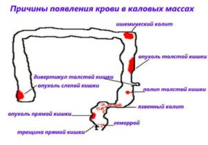 Когда ходишь по большому идет кровь. Причины и лечение крови из заднего прохода при испражнении