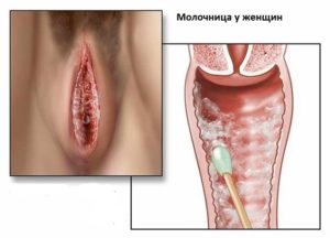 Началась молочница перед месячными как лечить. Молочница каждый месяц перед месячными что делать. Избавление от молочницы перед менструацией