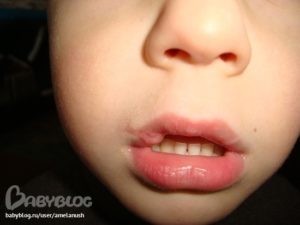 Ребенок разбил губу с внутренней стороны. Что делать, если малыш разбил губу