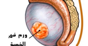 Причины и лечение уплотнений на коже мошонки. Шишка (нарост) на яичке у мужчины