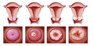Рыхлая шейка матки что это значит. Какой должна быть здоровая шейка матки