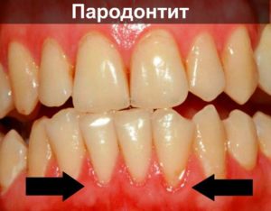 Десны чешутся и зудят: причины, лечение. Зудят нижние передние зубы