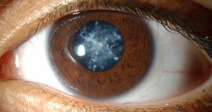 Удаление катаракты при глаукоме. Что такое катаракта и глаукома