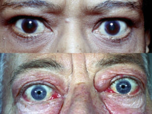 Выпучивать или вытаращивать глаза — это болезнь. Глаза на выкате у человека или экзофтальм — что это за болезнь? Выпирают глаза