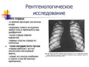 Тень сердца. Причины возникновения увеличенного сердца