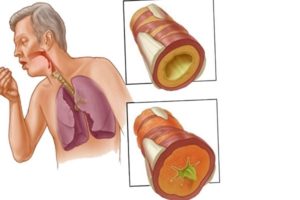 Почему и при каких обстоятельствах наступает смерть от пневмонии. Можно ли умереть от пневмонии и как не допустить летального исхода