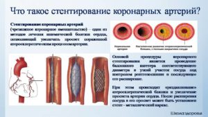 Стентирование сосудов сердца подготовка к операции. Существующий ряд неабсолютных противопоказаний. Операция стентирования сосудов сердца: что важно знать о ней