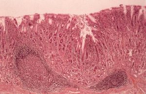 Очаговая гиперплазия слизистой желудка лечение. Что такое очаговая гиперплазия слизистой желудка