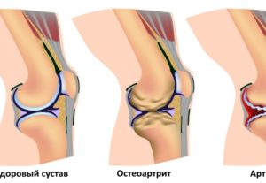 Скрипят суставы лечение. Скрип в коленном суставе при сгибании