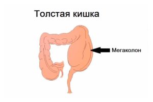 Как проявляется и лечится мегаколон у детей? Мегаколон у детей: что нужно делать? Лечение мегаколона кишечника