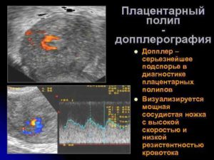 Полип эндометрия плацентарный с кровотоком. Плацентарный полип: что это такое? Что представляет собой плацентарный полип