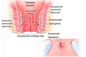 Укрепление сфинктера. Слабость сфинктера прямой кишки. Можно ли вылечить болезнь ЛФК