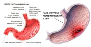 Ли подняться температура от желудка. Температура при гастрите, причины появления и способы борьбы с ней