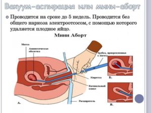 До какого срока делают вакуумный аборт, как он проходит, каковы последствия прерывания беременности? Вакуумное прерывание беременности: сроки и отзывы