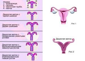 Гипоплазия матки или детская матка: степени, симптомы, причины, лечение.  Размеры матки в норме. Можно ли забеременеть с детской маткой