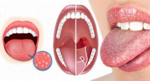 Воспаления языка. Воспаление сосочков на языке — причины, как лечить