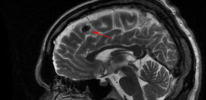 Дистрофические очаги в белом веществе головного мозга. Очаговые изменения вещества мозга дистрофического характера