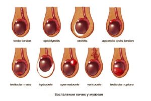 Причины и лечение уплотнений на коже мошонки. Шишка (нарост) на яичке у мужчины