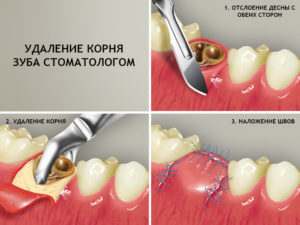 Разрушился зуб остались корни. Корень зуба остался в десне последствия